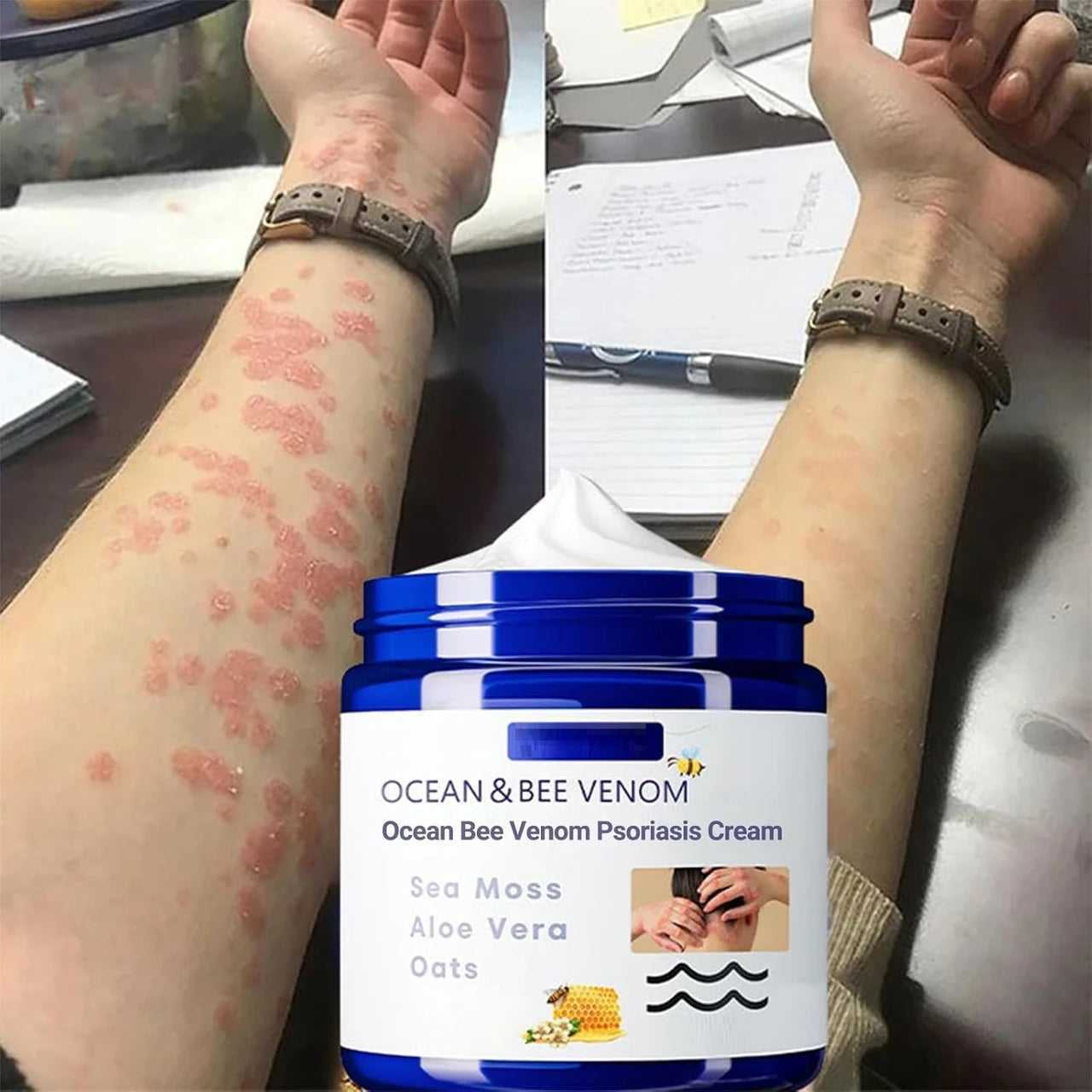 Bee Venom & Ocean Psoriasis Healing Cream (Pack Of 2)